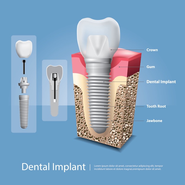 Denti umani ed illustrazione di vettore dell'impianto dentale