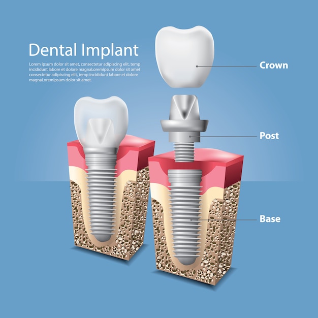 Vettore denti umani ed illustrazione di vettore dell'impianto dentale