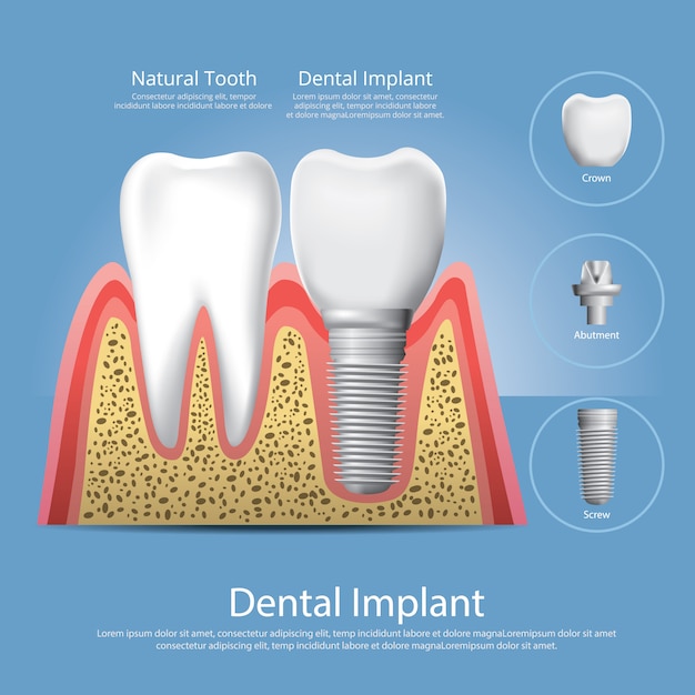 Human teeth and dental implant vector illustration