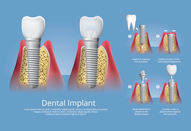 Human teeth and dental implant vector illustration