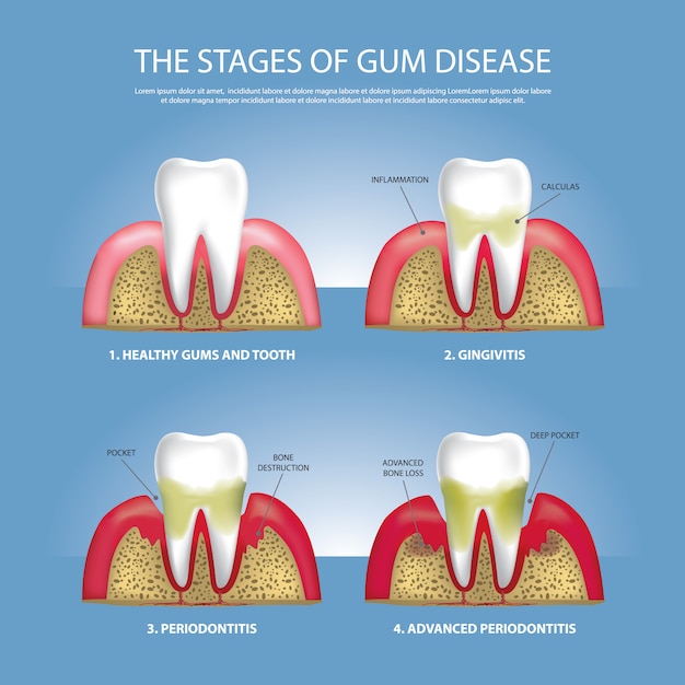 Vettore fasi dei denti umani dell'illustrazione della malattia di gomma