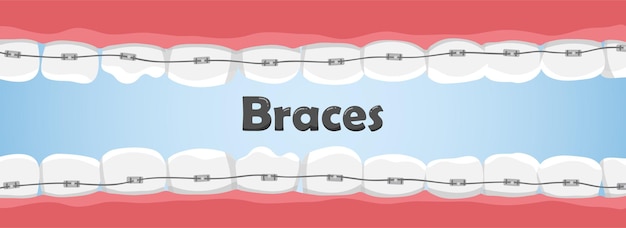 Denti umani con parentesi graffe in bocca. denti storti. concetto di cure odontoiatriche.