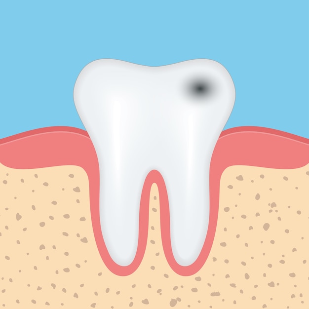 Dente umano con carie, problema di salute dei denti dentali.