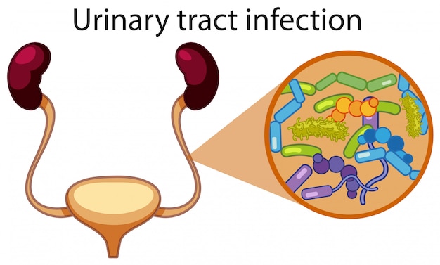 Vector human urinary tract infection