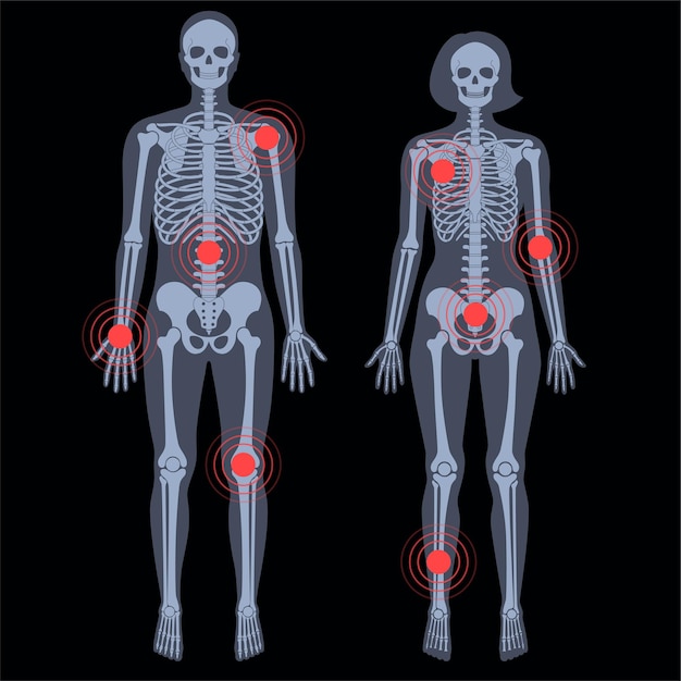 Vector human woman and man skeleton pain, fracture, inflammation in front on x ray view vector illustration