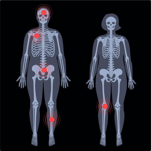 X線ビューで正面の人間の女性と男性の骨格の痛み、骨折または炎症。