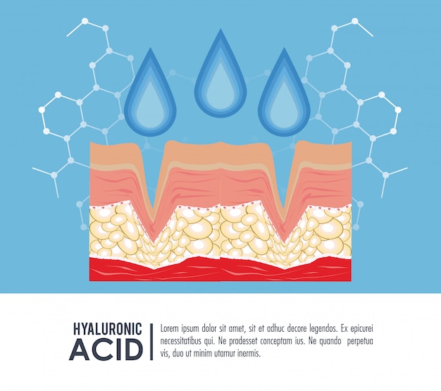 Hyaluronic acid filler injection infographic