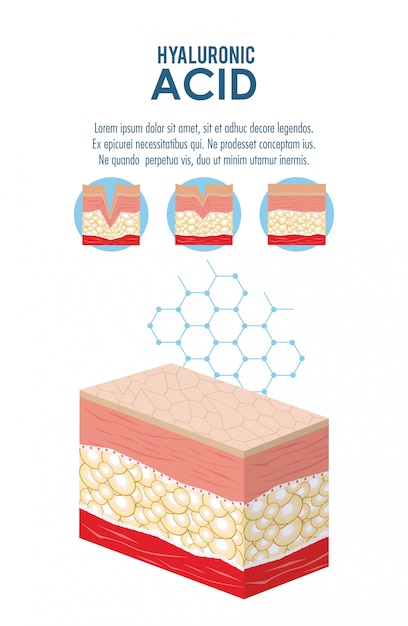 Hyaluronic acid filler injection infographic