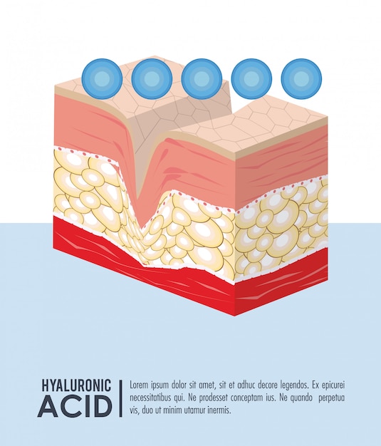 Infografica di riempimento di acido ialuronico