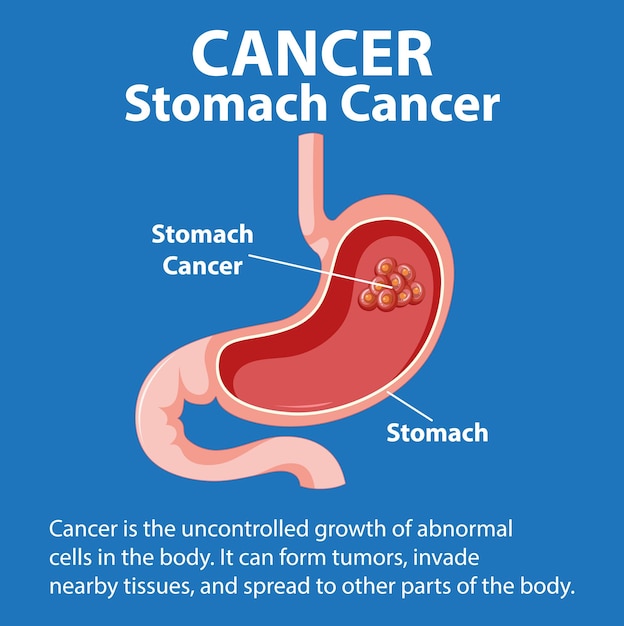 Illustrated infographic of stomach cancer growth