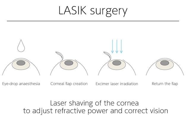 Illustratie LASIK visie correctie medische illustratie