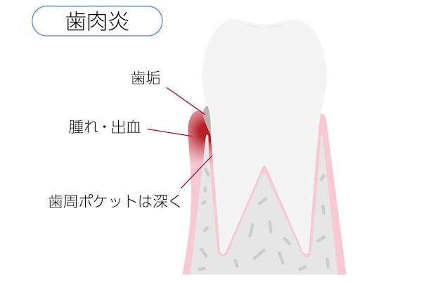 Illustratie per stadium van parodontitis gingivitis