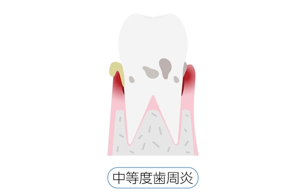 Illustratie per stadium van parodontitis matige parodontitis