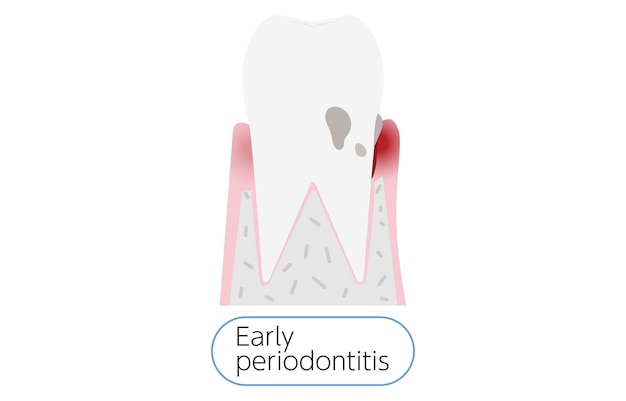 Illustratie per stadium van parodontitis vroege parodontitis