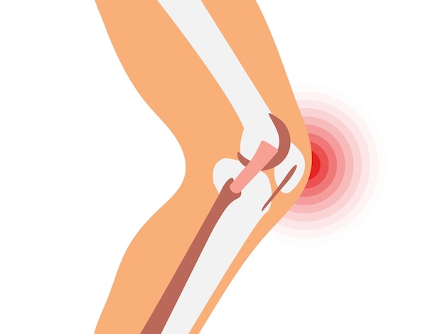 Illustratie van gewrichtspijn botpijn pijn artritis orthopedisch medisch pictogram anatomie van het menselijk been