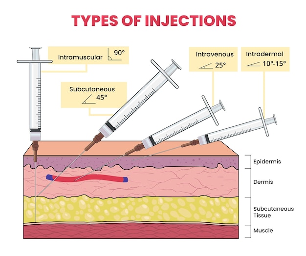 Vector illustratie van injectietypen infografiek