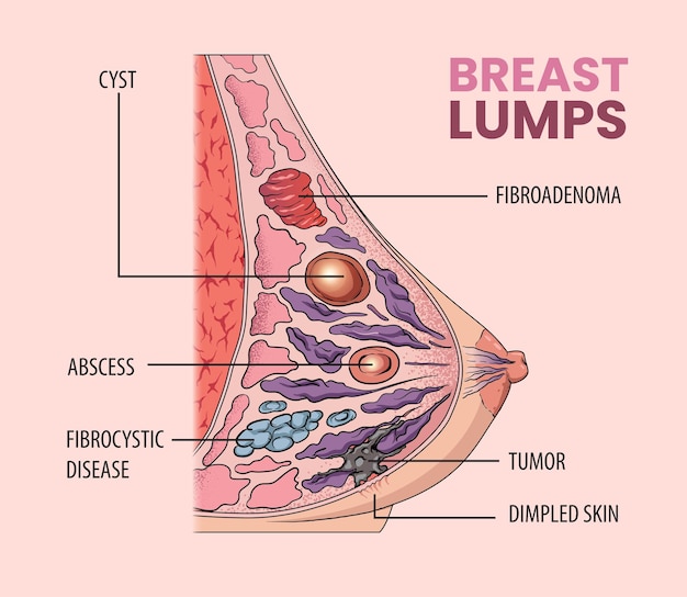 Illustratie van soorten borstknobbels bij vrouwen