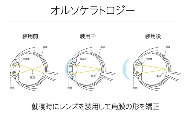 Illustraties Correctie van het gezichtsvermogen met orthokeratologie Medische illustraties