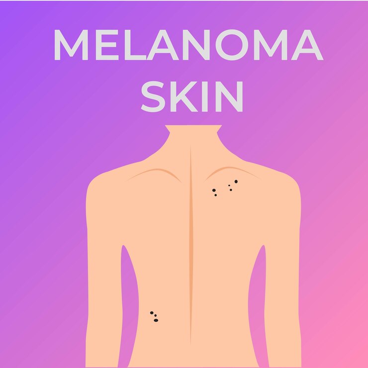 Vector illustration of a back affected by melanoma cartoon and simple style