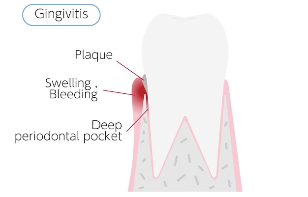 Vector illustration by stage of periodontal disease gingivitis