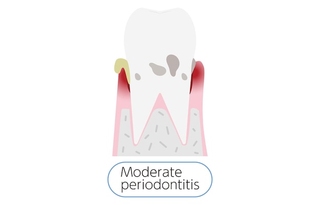 Illustration by stage of periodontal disease moderate periodontitis