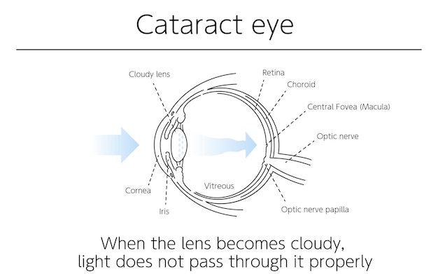 Vector illustration cataract eye medical illustrations