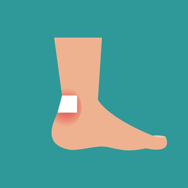 Vector illustration of foot with callus and plaster