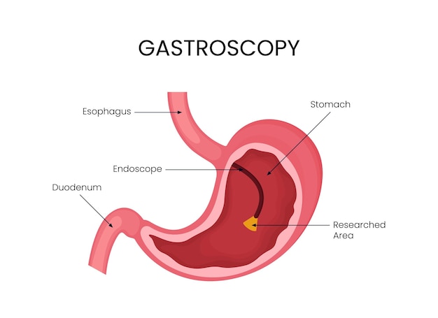 Vector illustration of gastroscopy disease diagram