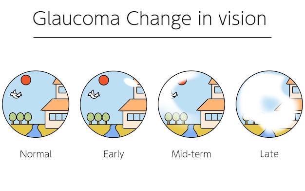 Illustrazione dei cambiamenti del glaucoma nel campo visivo man mano che il glaucoma progredisce illustrazioni mediche