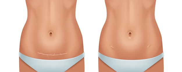 Vector illustration of healed scars human skin after cesarean operation