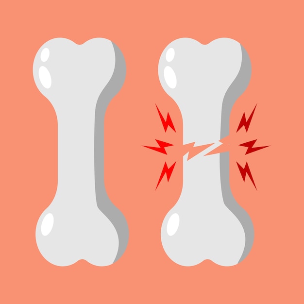 Vector illustration of healthy bones and fractured bones.