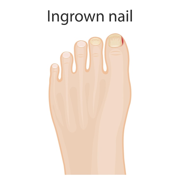 Vettore illustrazione di piedi sani piedi con unghie incrostate trattamento di dita e dita incrostate