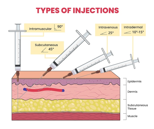 Vector illustration of injection types infographic