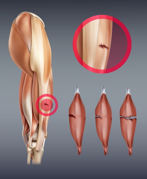 Vettore illustrazione della lesione muscolare alla gamba