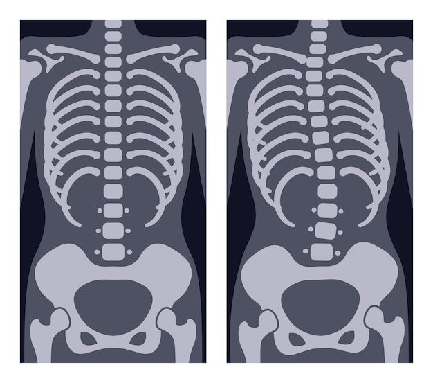 Illustration of a normal spine and a spine with scoliosis