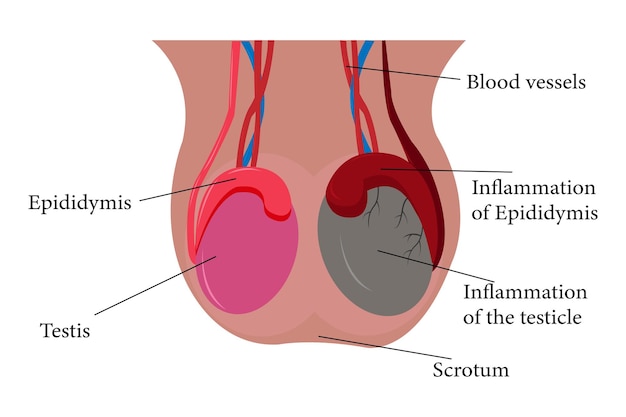 Вектор Иллюстрация сравнения эпидидимита орхита eps 10
