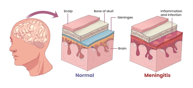 Иллюстрация мембран воспаления менингита, покрывающих мозг