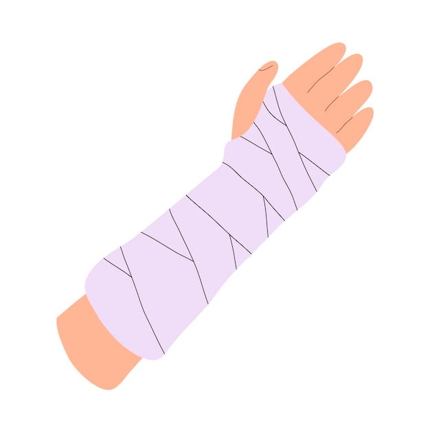 Вектор Иллюстрация гипсовой повязки на сломанной руке