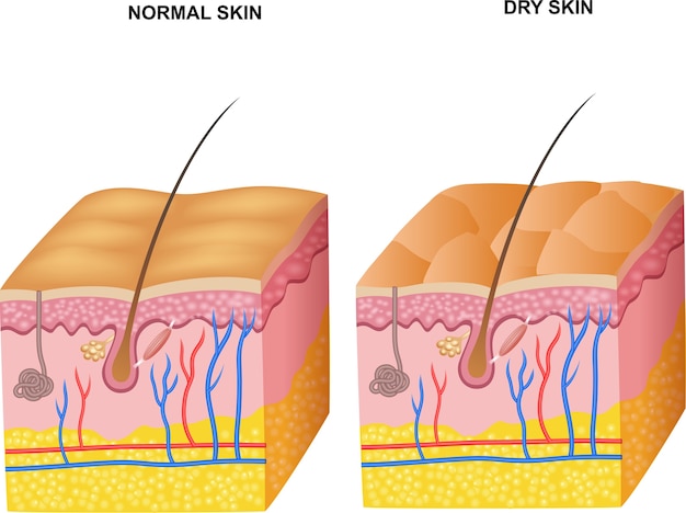 벡터 정상적인 피부와 건성 피부 층의 그림