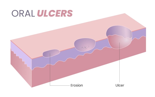 Vector illustration of oral ulcer diagram