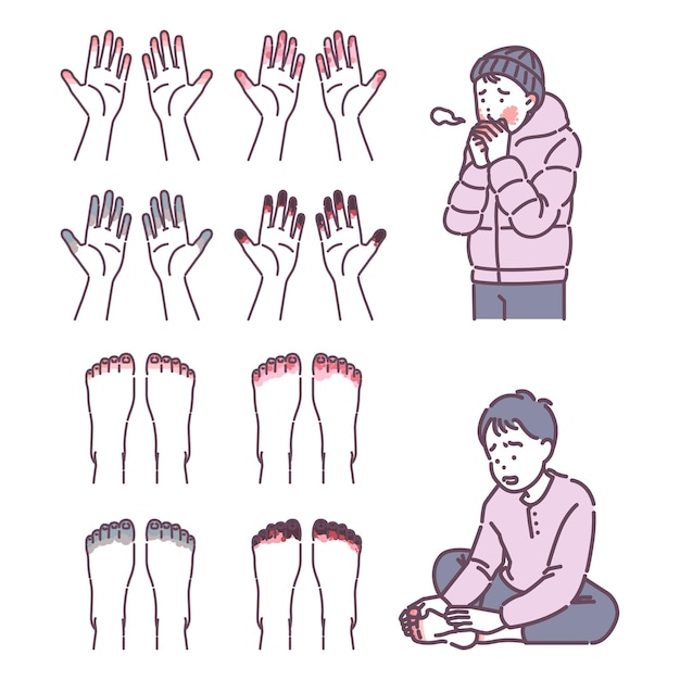 Vector illustration of a person with frostbite on his hand and foot