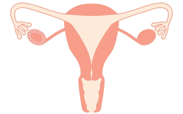 Vector illustration of polycystic ovary syndrome maturation disorder anatomy of the uterus and ovaries