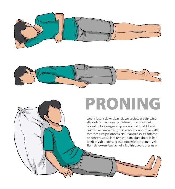 Illustrazione del posizionamento prono o prono
