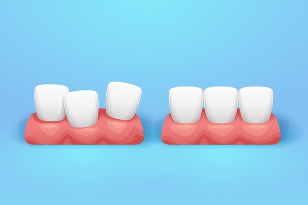 Illustration of shiny straight and crooked teeth on gums on blue backdrop