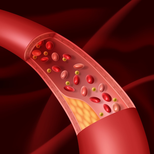 Vector illustration of vascular atherosclerosis cutaway view of accumulated plaque in an afflicted blood vessel.