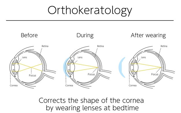 Vector illustrations correction of vision with orthokeratology medical illustrations