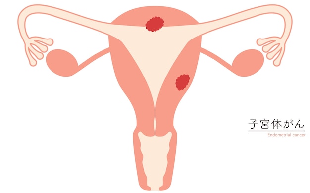 Vector illustrative illustrations of endometrial cancer anatomy of the uterus and ovaries