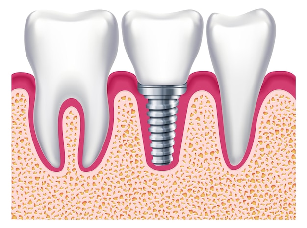 健康な歯の間にインプラント 歯科治療 歯科 義肢