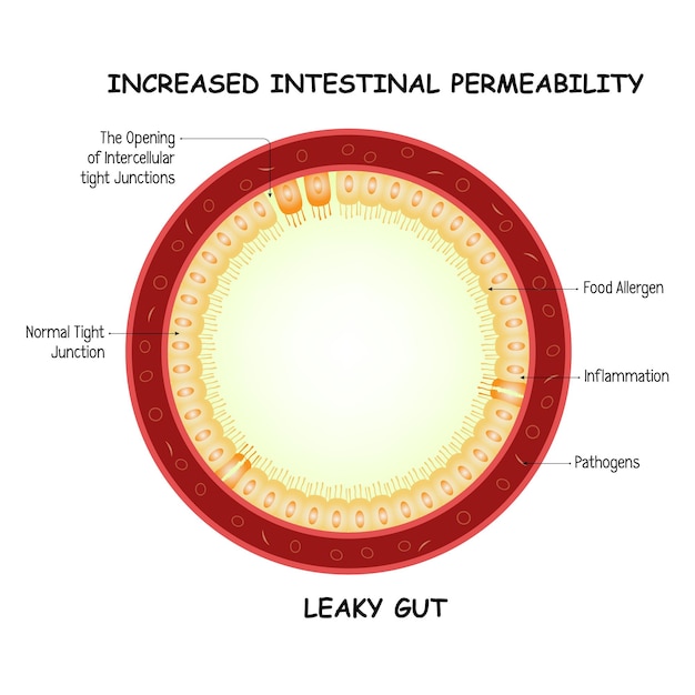 Aumento della permeabilità intestinale