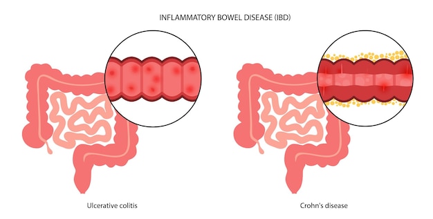 Inflammatoire darmziekte